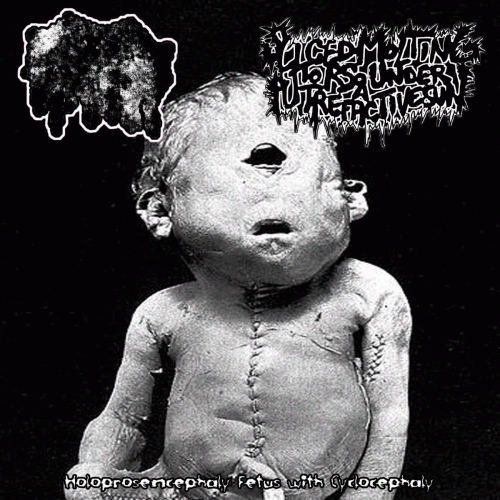 Fetus Demersus : Holoprosencephaly Fetus with Cyclocephaly